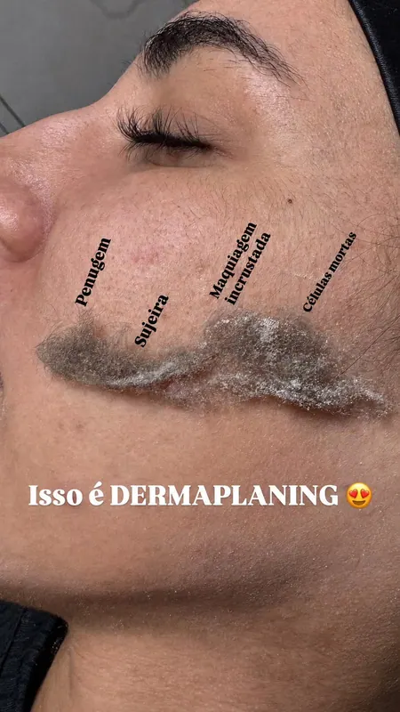 Dermaplaning removendo células mortas e pelos finos do rosto