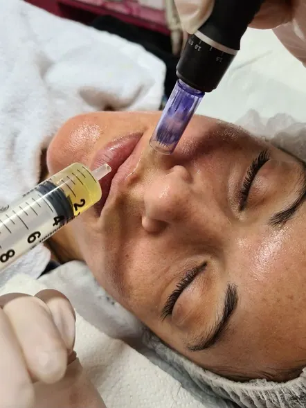 Sessão de microagulhamento facial com aplicação de ativos