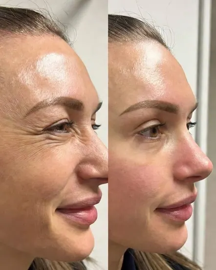 Antes e depois de skinbooster com pele mais hidratada e luminosa